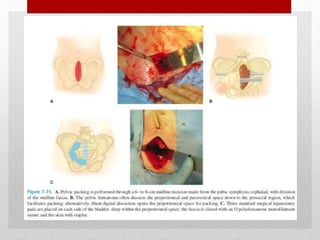 • IDENTIFICATION OF INJURIES
• PELVIC BINDER
• EXFIX
• PRE PERITONEAL PELVIC PACKING
 