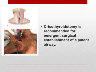• Cricothyroidotomy is
recommended for
emergent surgical
establishment of a patent
airway.
 