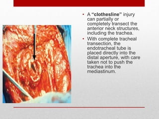 • A “clothesline” injury
can partially or
completely transect the
anterior neck structures,
including the trachea.
• With complete tracheal
transection, the
endotracheal tube is
placed directly into the
distal aperture, with care
taken not to push the
trachea into the
mediastinum.
 
