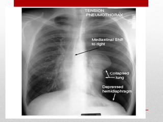 Tension pneumothorax
Breathing and
Ventilation
 