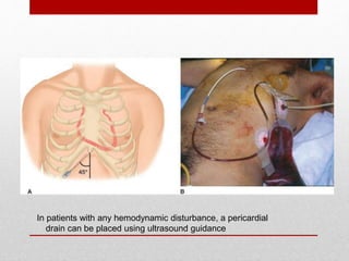 In patients with any hemodynamic disturbance, a pericardial
drain can be placed using ultrasound guidance
 