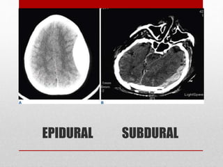 EPIDURAL SUBDURAL
 