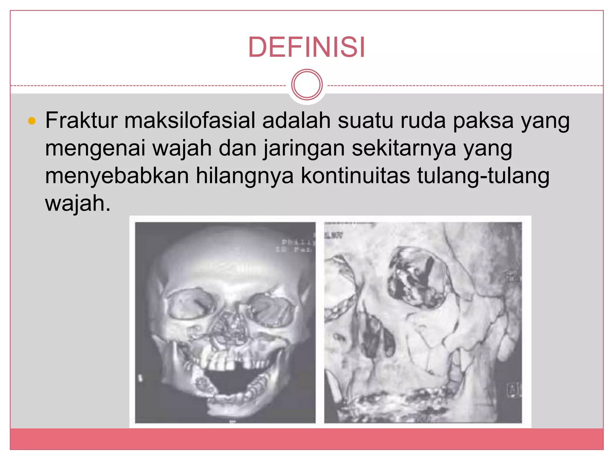 Trauma maksilofasial | PPTX