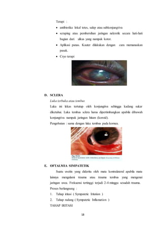 18
Terapi :
 antibiotika lokal tetes, salep atau subkonjungtiva
 scraping atau pembersihan jaringan nekrotik secara hati-hati
bagian dari ulkus yang nampak kotor.
 Aplikasi panas. Kauter dilakukan dengan cara memanaskan
pasak.
 Cryo terapi
D. SCLERA
Luka terbuka atau tembus
Luka ini lekas tertutup oleh konjungtiva sehingga kadang sukar
diketahui. Luka tembus sclera harus dipertimbangkan apabila dibawah
konjungtiva nampak jaringan hitam (koroid).
Pengobatan : sama dengan luka tembus pada kornea.
E. OFTALMIA SIMPATETIK
Suatu uveitis yang diderita oleh mata kontralateral apabila mata
lainnya mengalami trauma atau trauma tembus yang mengenai
jaringan uvea. Frekuensi tertinggi terjadi 2-4 minggu sesudah trauma.
Proses berlangsung :
1. Tahap iritasi ( Sympatetic Iritation )
2. Tahap radang ( Sympatetic Inflamation )
TAHAP IRITASI
 