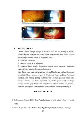 24
3) TRAUMA TERMAL
Trauma karena uapnya merupakan sekunder dari api nya sedangkan kontak
langsung karena terekspos dari larutan panas ataupun benda yang panas. Derajat
keparahan pada trauma termal ini bergantung pada:
1. Temperatur dari objek
2. Luas area yang terkena suhu panas
3. Lamanya durasi kontak Kebanyakan trauma termal mengenai permukaan
superfisial dari epitelium kornea dan konjungtiva.
Luka bakar pada superfisial cenderung menyebabkan kornea keabuan-abuan dan
opasifikasi Adanya nekrosis jaringan di debridement dengan perlahan. Pemberian
siklopegik dan patching penting. Antibiotik tetes diberikan jika ada abrasi pada
kornea. Umumnya luka bakar superfisial penyembuhan pada 24-48 jam tanpa
sequele. Trauma yang berat dapat menyebabkan nekrosis kornea dan perforasi.
Intervensi keratoplasti dan transplantasi stem sel limbal dapat dipertimbangkan
DAFTAR PUSTAKA
1. Tjokronegoro, Arjatmo. 2003. Ilmu Penyakit Mata,3 rd edisi. Jakarta : Balai Penerbit
FKUI
2. James, Bruce, et al. 2006 . Lecture Notes Oftalmologi, 9th eds. Surabaya : Airlangga.
 