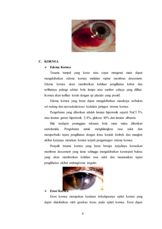 4
C. KORNEA
 Edema Kornea
Trauma tumpul yang keras atau cepat mengenai mata dapat
mengakibatkan edema kornea malahan ruptur membran descement.
Edema kornea akan memberikan keluhan penglihatan kabur dan
terlihatnya pelangi sekitar bola lampu atau sumber cahaya yang dilihat.
Kornea akan terlihat keruh dengan uji placido yang positif.
Edema kornea yang berat dapat mengakibatkan masuknya serbukan
sel radang dan neovaskularisasi kedalam jaringan stroma kornea.
Pengobatan yang diberikan adalah larutan hipertonik seperti NaCl 5%
atau larutan garam hipertonik 2-8%, glukose 40% dan larutan albumin.
Bila terdapat peninggian tekanan bola mata maka diberikan
azetolamida. Pengobatan untuk menghilangkan rasa sakit dan
memperbaiki tajam penglihatan dengan lensa kontak lembek dan mungkin
akibat kerjanya menekan kornea terjadi pengurangan edema kornea.
Penyulit trauma kornea yang berat berupa terjadinya kerusakan
membran descement yang lama sehingga mengakibatkan keratopati bulosa
yang akan memberikan keluhan rasa sakit dan menurunkan tajam
penglihatan akibat astimagtisme ireguler.
 Erosi Kornea
Erosi kornea merupakan keadaan terkelupasnya epitel kornea yang
dapat diakibatkan oleh gesekan keras pada epitel kornea. Erosi dapat
 