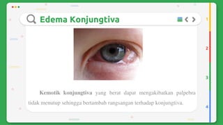 Trauma mekanik mata