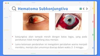 Trauma mekanik mata