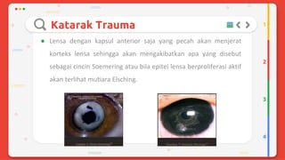 Trauma mekanik mata