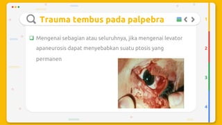 Trauma mekanik mata