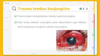 Trauma mekanik mata