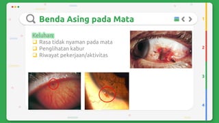 Trauma mekanik mata