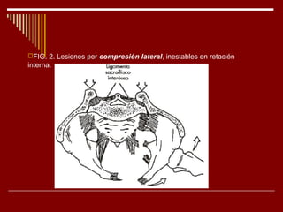 FIG. 2. Lesiones por compresión lateral, inestables en rotación
interna.
 