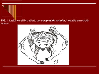 FIG. 1. Lesión en el libro abierto por  compresión anterior , inestable en rotación interna 
