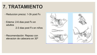 7. TRATAMIENTO
◦ Reduccion precoz: 1-3h post Fx
◦ Edema: 2-6 dias post Fx en
adultos
2-3 dias post Fx en niños
◦ Recomendación: Reposo con
elevacion de cabecera en 30º
 