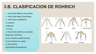 3.B. CLASIFICACION DE ROHRICH
1. FRACTURA SIMPLE UNILATERAL
2. FRACTURA SIMPLE BILATERAL
3. FRACTURA CONMINUTA:
a) Unilateral
b) Bilateral
c) Frontal
4. FRACTURA COMPLEJA (HUESOS
NASALES Y SEPTOS)
a) Con hematoma septal asociado
b) Con laceraciones nasales
5. FRACTURAS
NASOORBITOETMOIDALES
 
