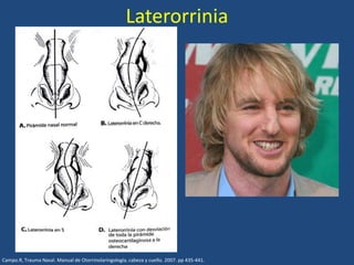 Laterorrinia
Campo.R, Trauma Nasal. Manual de Otorrinolaringología, cabeza y cuello. 2007. pp 435-441.
 