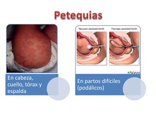 En cabeza, 
cuello, tórax y 
espalda 
En partos difíciles 
(podálicos) 
 