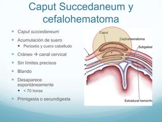 Caput Succedaneum y
          cefalohematoma
 Caput succedaneum
 Acumulación de suero
    Periostio y cuero cabelludo
 Cráneo  canal cervical
 Sin límites precisos
 Blando
 Desaparece
   espontáneamente
    < 70 horas
 Primigesta o secundigesta
 