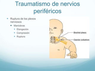 Traumatismo de nervios
           periféricos
 Ruptura de los plexos
  nerviosos
   Maniobras
      Elongación
      Compresión
      Ruptura
 