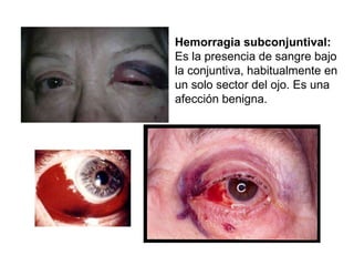 Hemorragia subconjuntival:  Es la presencia de sangre bajo la conjuntiva, habitualmente en un solo sector del ojo. Es una afección benigna. 