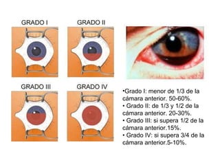 Grado I: menor de 1/3 de la cámara anterior. 50-60%. •  Grado II: de 1/3 y 1/2 de la cámara anterior. 20-30%. •  Grado III: si supera 1/2 de la cámara anterior.15%. •  Grado IV: si supera 3/4 de la cámara anterior.5-10%. 