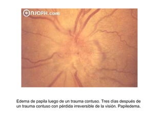 Edema de papila luego de un trauma contuso. Tres días después de un trauma contuso con pérdida irreversible de la visión. Papiledema. 