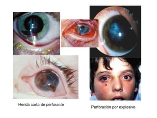 Herida cortante perforante Perforación por explosivo 