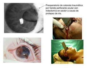 Preoperatorio de catarata traumática por herida perforante ocular con iridectomía en sector a causa de prolapso de iris.  