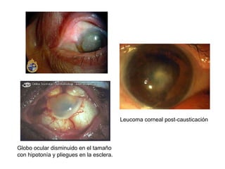 Leucoma corneal post-causticación Globo ocular disminuido en el tamaño con hipotonía y pliegues en la esclera.  