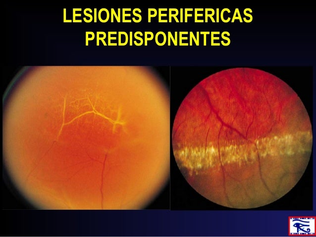 Lesiones Predisponentes A Desprendimiento De Retina es.slideshare.net