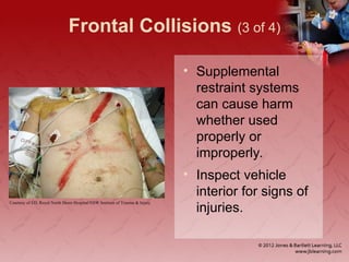 Frontal Collisions (3 of 4)
• Supplemental
restraint systems
can cause harm
whether used
properly or
improperly.
• Inspect vehicle
interior for signs of
injuries.
Courtesy of ED, Royal North Shore Hospital/NSW Institute of Trauma & Injury
 