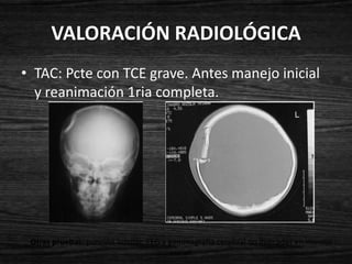 VALORACIÓN RADIOLÓGICA
• TAC: Pcte con TCE grave. Antes manejo inicial
  y reanimación 1ria completa.




 Otras pruebas: punción lumbar, EEG y gammagrafía cerebral no indicadas en manejo
                                       inicial.
 