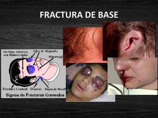 FRACTURA DE BASE
 