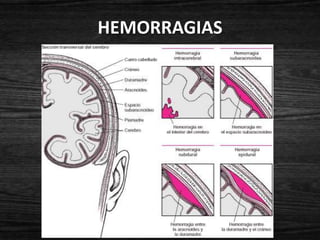 HEMORRAGIAS
 