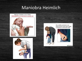 Maniobra Heimlich
 