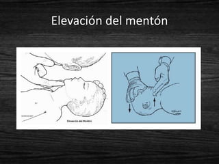 Elevación del mentón
 