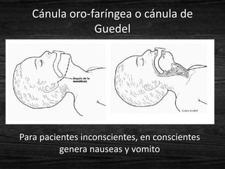 Cánula oro-faríngea o cánula de
               Guedel




Para pacientes inconscientes, en conscientes
          genera nauseas y vomito
 