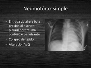 Neumotórax simple

• Entrada de aire a baja
  presión al espacio
  pleural por trauma
  contuso o penetrante
• Colapso de tejido
• Alteración V/Q
 
