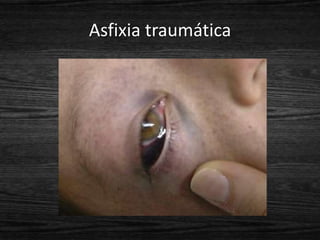 Asfixia traumática
 
