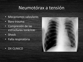 Neumotórax a tensión
• Mecanismos valvulares
• Baro trauma
• Compresión de las
  estructuras torácicas
• Shock
• Falla respiratoria

• DX CLINICO
 