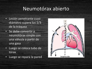 Neumotórax abierto
• Lesión penetrante cuyo
  diámetro supera los 2/3
  de la tráquea
• Se debe convertir a
  neumotórax simple con
  una válvula a partir de
  una gasa
• Luego se coloca tubo de
  tórax
• Luego se repara la pared
 