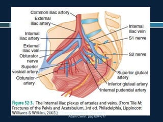 TRAUMA. Chapter 52 Pelvic Trauma Stephen B. Choi and A.
Adam Cwinn. pag 604-617
 