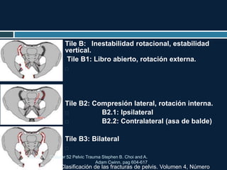 Tile B: Inestabilidad rotacional, estabilidad
vertical.
Tile B1: Libro abierto, rotación externa.

Tile B2: Compresión lateral, rotación interna.
 B2.1: Ipsilateral
 B2.2: Contralateral (asa de balde)
Tile B3: Bilateral

TRAUMA. Chapter 52 Pelvic Trauma Stephen B. Choi and A.
Adam Cwinn. pag 604-617
Mella Schmidt C y col. Clasificación de las fracturas de pelvis. Volumen 4, Número
 