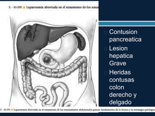 TRAUMA. Chapter 52 Pelvic Trauma Stephen B. Choi and A.
Adam Cwinn. pag 604-617
 Contusion
pancreatica
 Lesion
hepatica
Grave
 Heridas
contusas
colon
derecho y
delgado
 
