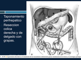 TRAUMA. Chapter 52 Pelvic Trauma Stephen B. Choi and A.
Adam Cwinn. pag 604-617
 Taponamiento
perihepatico
 Reseccion
colica
derecha y de
delgado con
grapas.
 