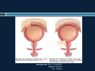 emergencias 2001;13:348-350
Bladder Trauma
N.L. Türkeri
 