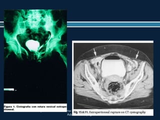 TRAUMA. Chapter 52 Pelvic Trauma Stephen B. Choi and A.
Adam Cwinn. pag 604-617
 