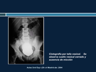 Actas Urol Esp v.28 n.4 Madrid abr. 2004
Cistografía por talla vesical.  Se
observa cuello vesical cerrado y
ausencia de micción
 