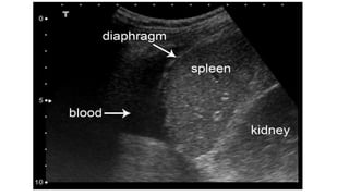 Trauma Ultrasound: What you need to know | PPTX